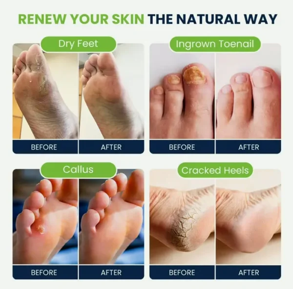 Tea-Tree Foot Soak for Nail Repair
