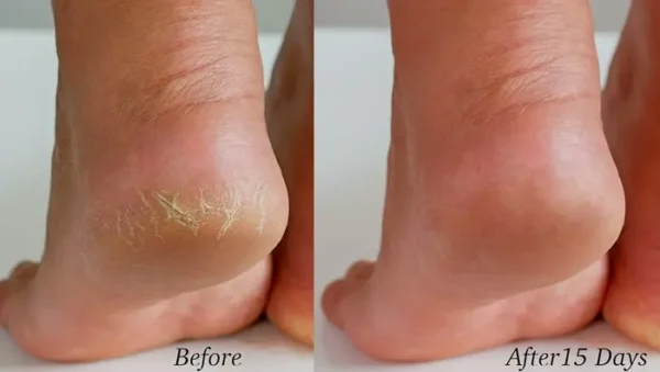 Crafted Tea Tree Salve - Foot Care, Nourish, Anti-Fungal - 2 oz